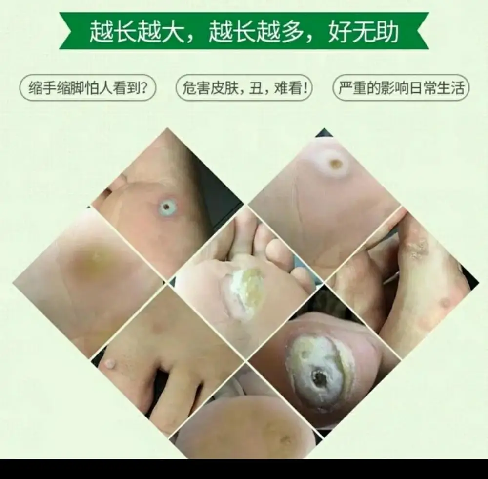 10 мл мозоли Уход за ногами медицинское удаление ног кукурузные бородавки жгучие