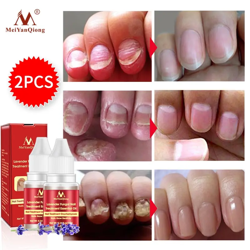 Эссенция для ремонта ногтей сыворотка Лечение грибка Удаление онихомикоза