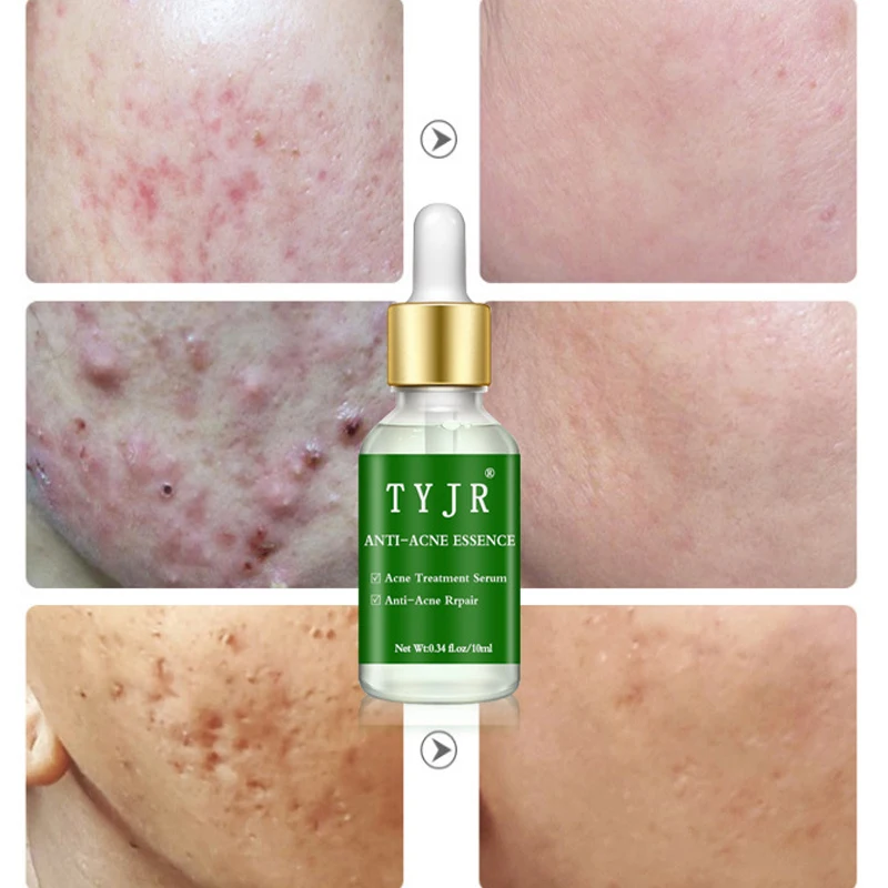 Основа под макияж эссенция для акне с алоэ увлажняющее масло кожи сыворотка лица