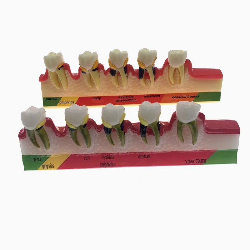 

Dentist Odontologia Periodontal Disease Dental Teeth Model Tooth dental Model 5 Stage