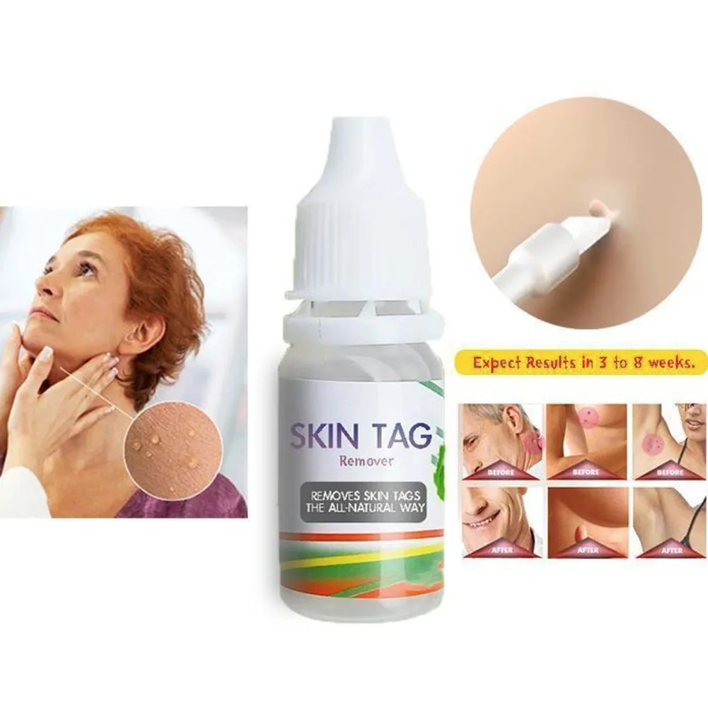 Body Skin Care Medical Tag Kill Mole Wart Remover Effective 10ml | Красота и здоровье