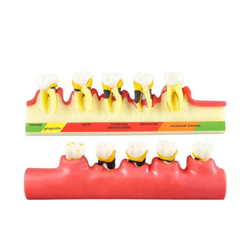 Periodontal disease display model/Oral Teeth Model Periodontal Disease Model /Dental disease tooth model M4010