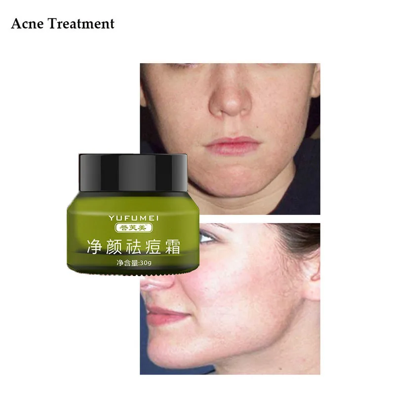 

Acne Treatment Face Cream Anti Acne Scar Removal Pimple Blackhead Moisturizing Whiten Oil-control Shrink Pores Skin Care