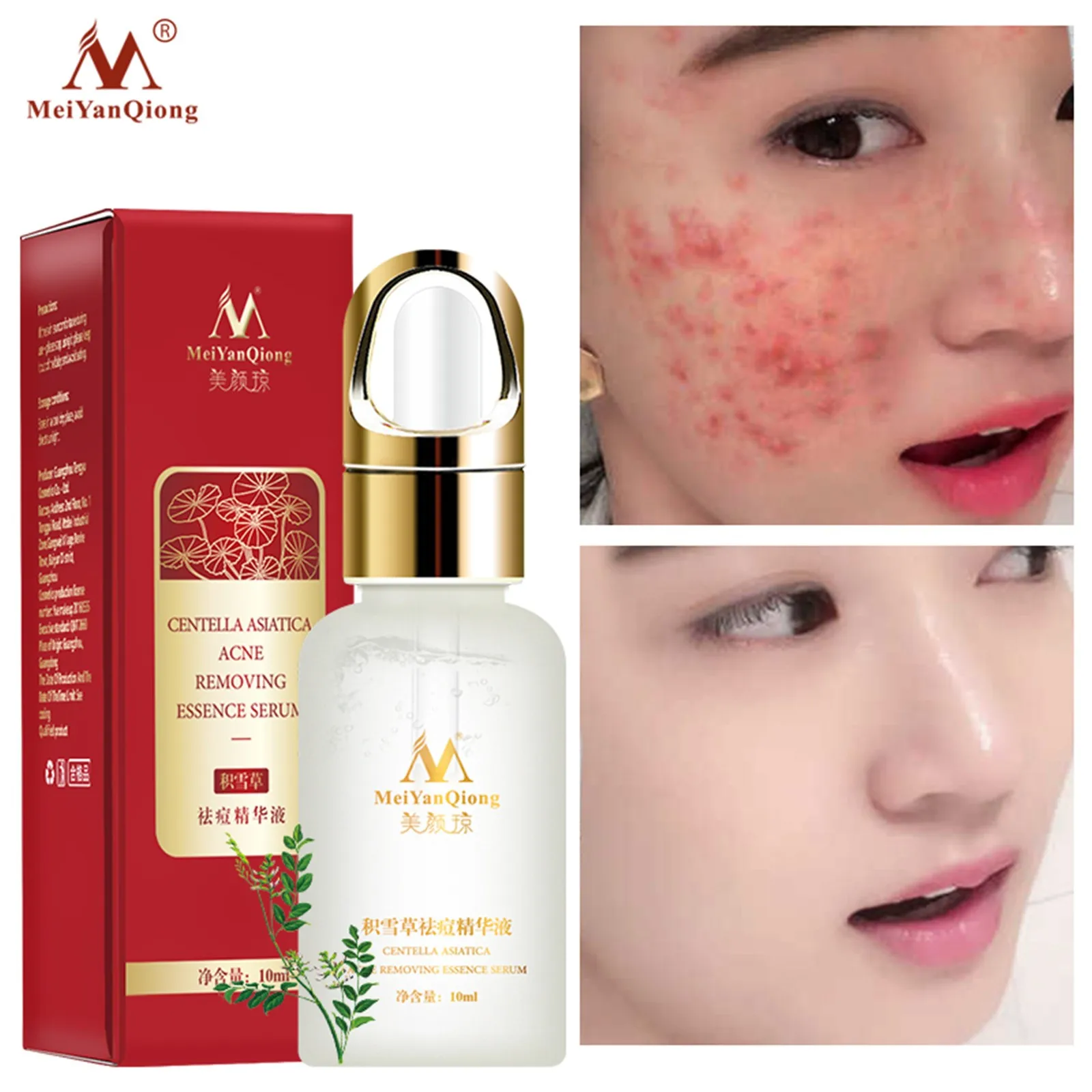 Лечение акне уход за кожей лица Сыворотки центеллы азиатской масляный