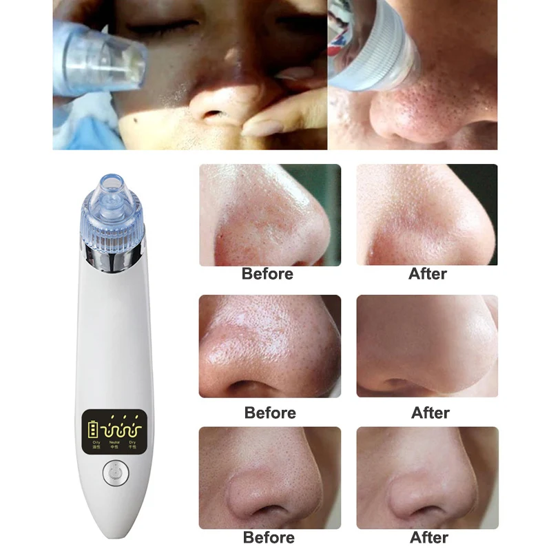 Угри пор вакуумный ЖК-дисплей Электрический акне прыщей Инструменты для