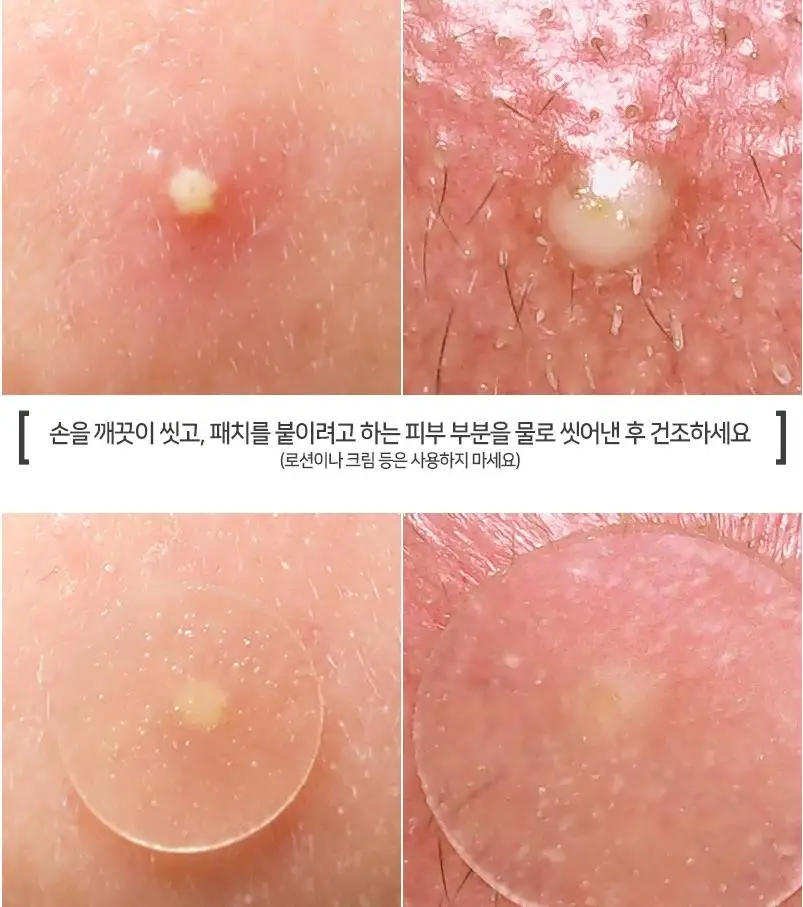 Маска для лица COSRX против акне прыщей ухода за кожей пятнами шрамов лечения