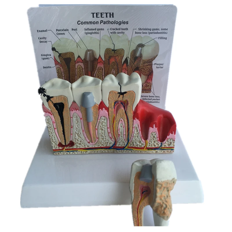 Sick tooth model worm decay tooth disease dental rash teaching aid beauty tooth cavity repair gingival inflammation teaching