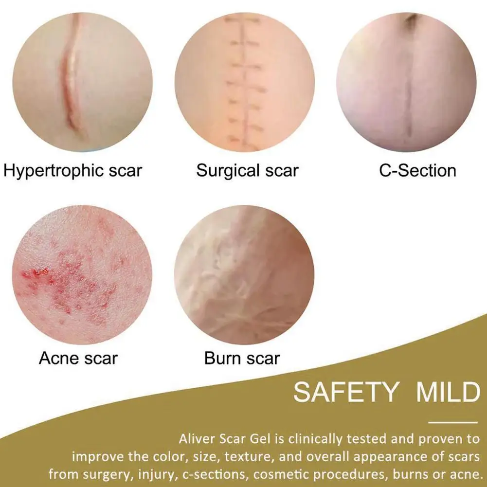 

Reusable Silicone Scar Sheets Removal Patch Acne Gel Scar Patch Silicon Remove Therapy Trauma Burn Sheet Skin Repair K9V6