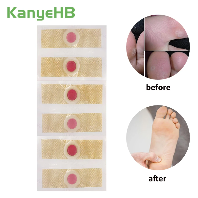 12 шт. медицинские пластыри для удаления мозолей бородавки шипы лечебные мозоли