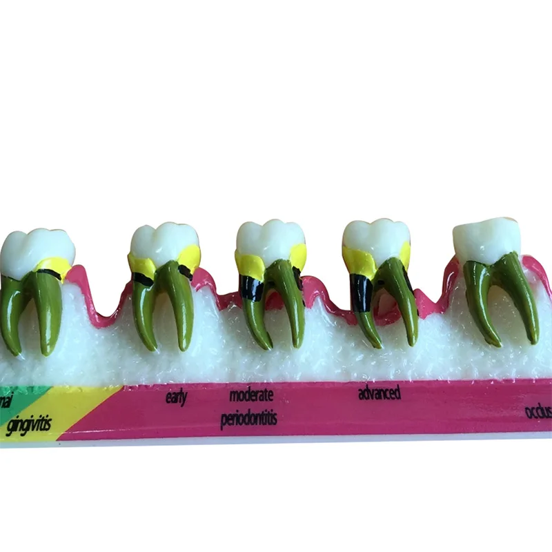 Стоматологическая модель зубов Пародонтоз ассортная классификации зубов|dental