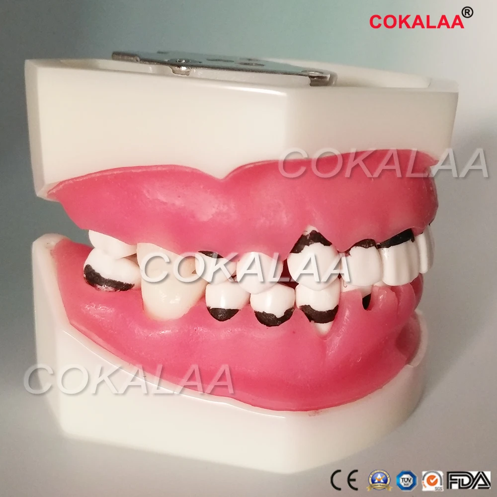 

Dental Periodontal Disease Model / Medical and teaching teeth Model