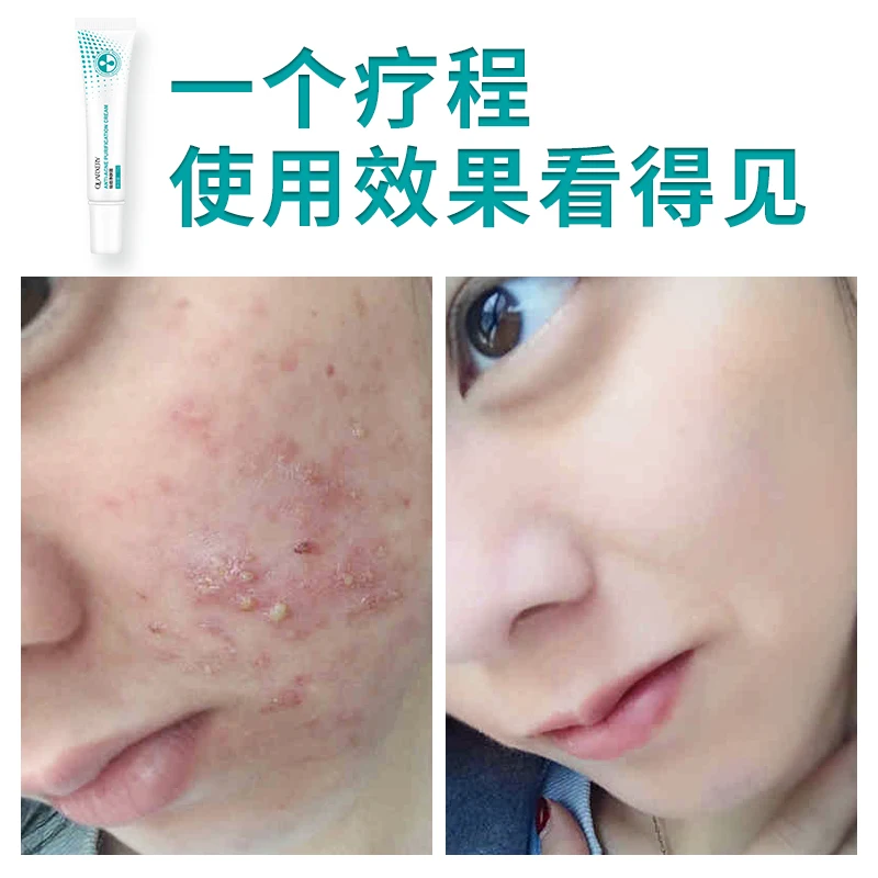 Quartxery быстрое удаление Ance отбеливающий увлажняющий крем для удаления кожи мужчин