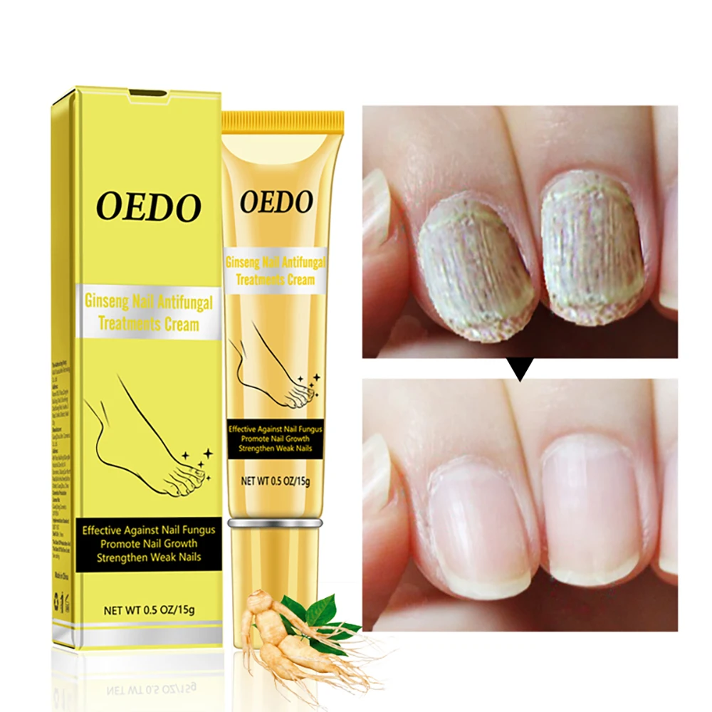 

Fungal Nail Treatment Cream Onychomycosis Paronychia Anti-Fungal Nail Infection Herbal Toe Fungus Foot Repair Essence Care Serum