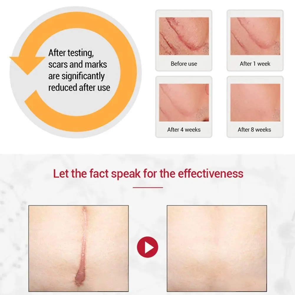 

30g Acne Scar Removal Cream Pimples Stretch Marks Face Gel Remove Acne Smoothing Whitening Moisturizing Face Body Skin Care