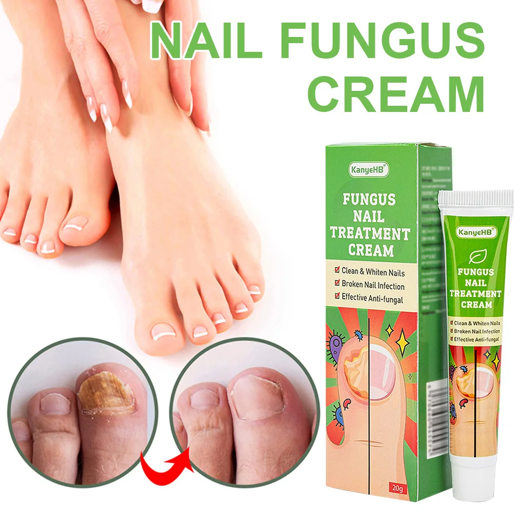 

Nail Fungus Treatment Cream Nail Repair Ointment Restore Discolored Damaged Nails Promote New Growth Nail Care