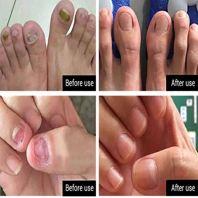 

Fungal Nail Treatment Essence Onychomycosis Paronychia Anti Fungal Nail Infection Chinese Herbal Toe Nail Fungus Treatment