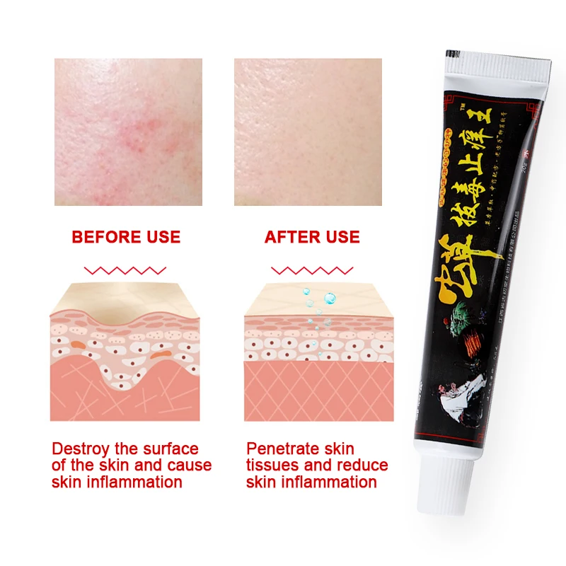 

1Pcs 20G Psoriasi Ointment Eczema Cream Skin Antipruritic Dermatitis Pruritus Bacterial Infection Herbal Ointment Skin Care