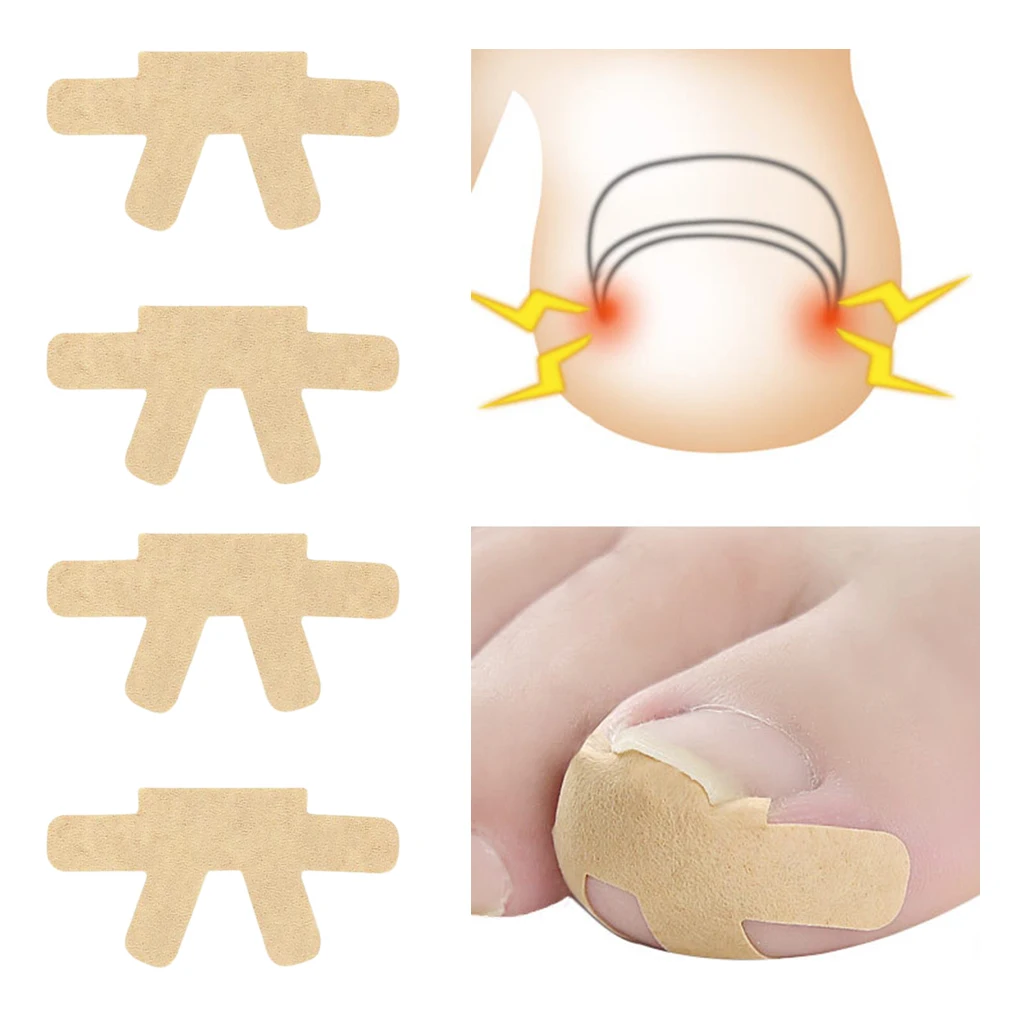 

4 Pcs Ingrown Toe Nail Correction Sticker Patch Paronychia Treatment Foot Care