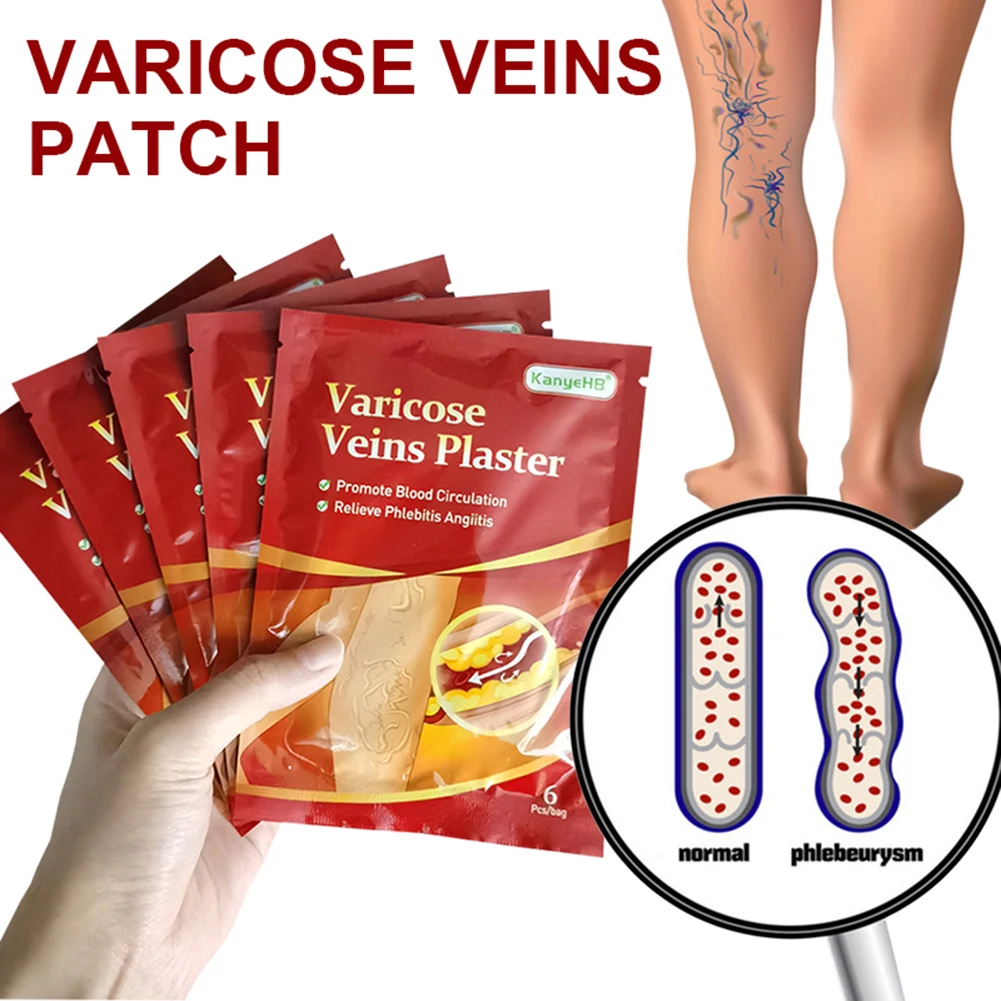 

6/12/24/pcs Varicose Veins Plaster Traditional Medicine Vasculitis Phlebitis Cream Leg Medical Patch Angiitis Removal Patch