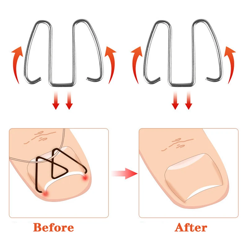 3 пары передний крючок для ногтей/резиновая лента нейл-арта коррекция вросших