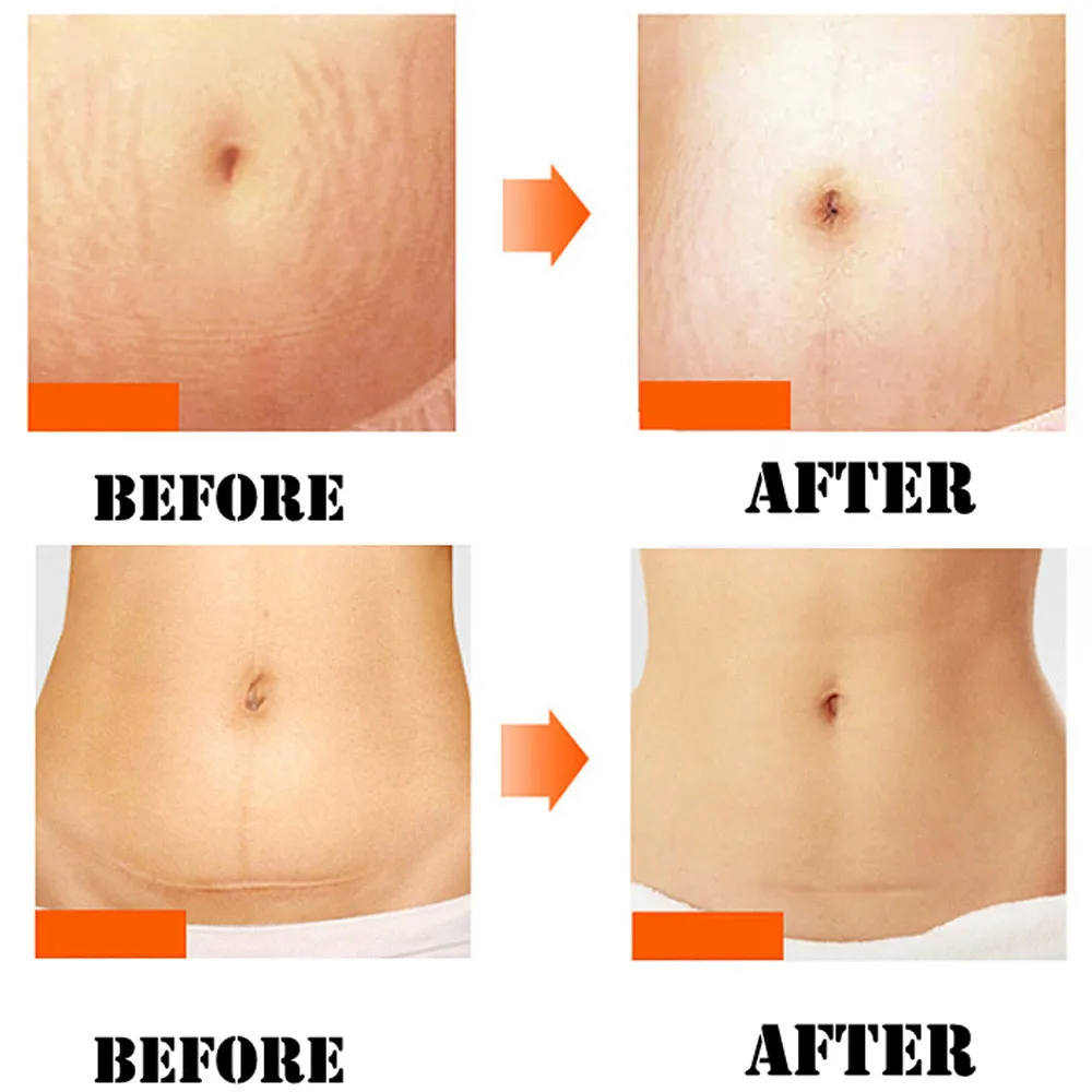 Стрии Gravidarum восстанавливающий крем для удаления рубцов от акне стрейч Знаки жира