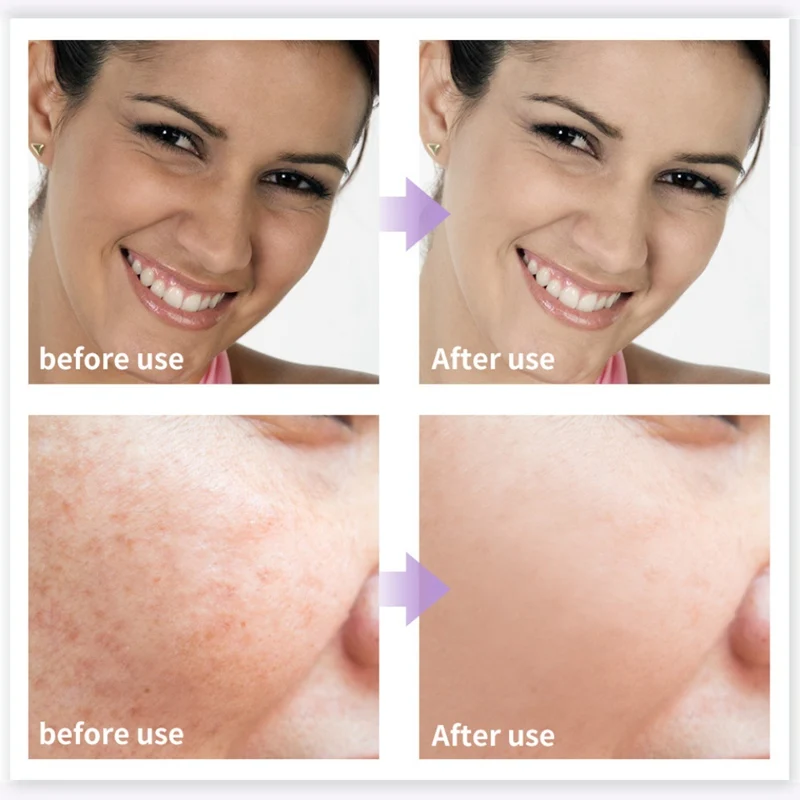 Nicotinamide стоковый раствор стойкий Увлажняющий Осветляющий пигмент тон кожи