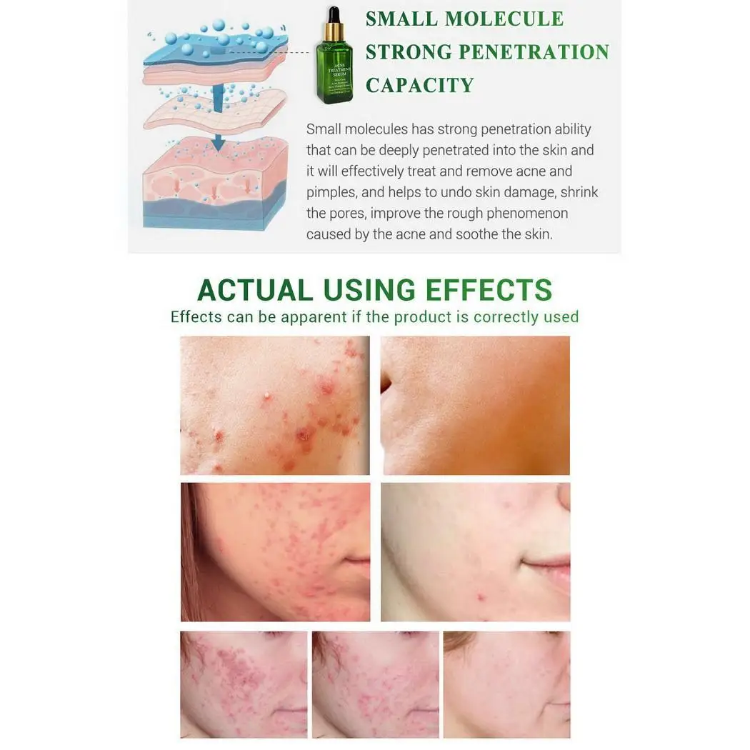 Угревая угревая головка усадка поры ремонт Сделано Китай маска для носа против