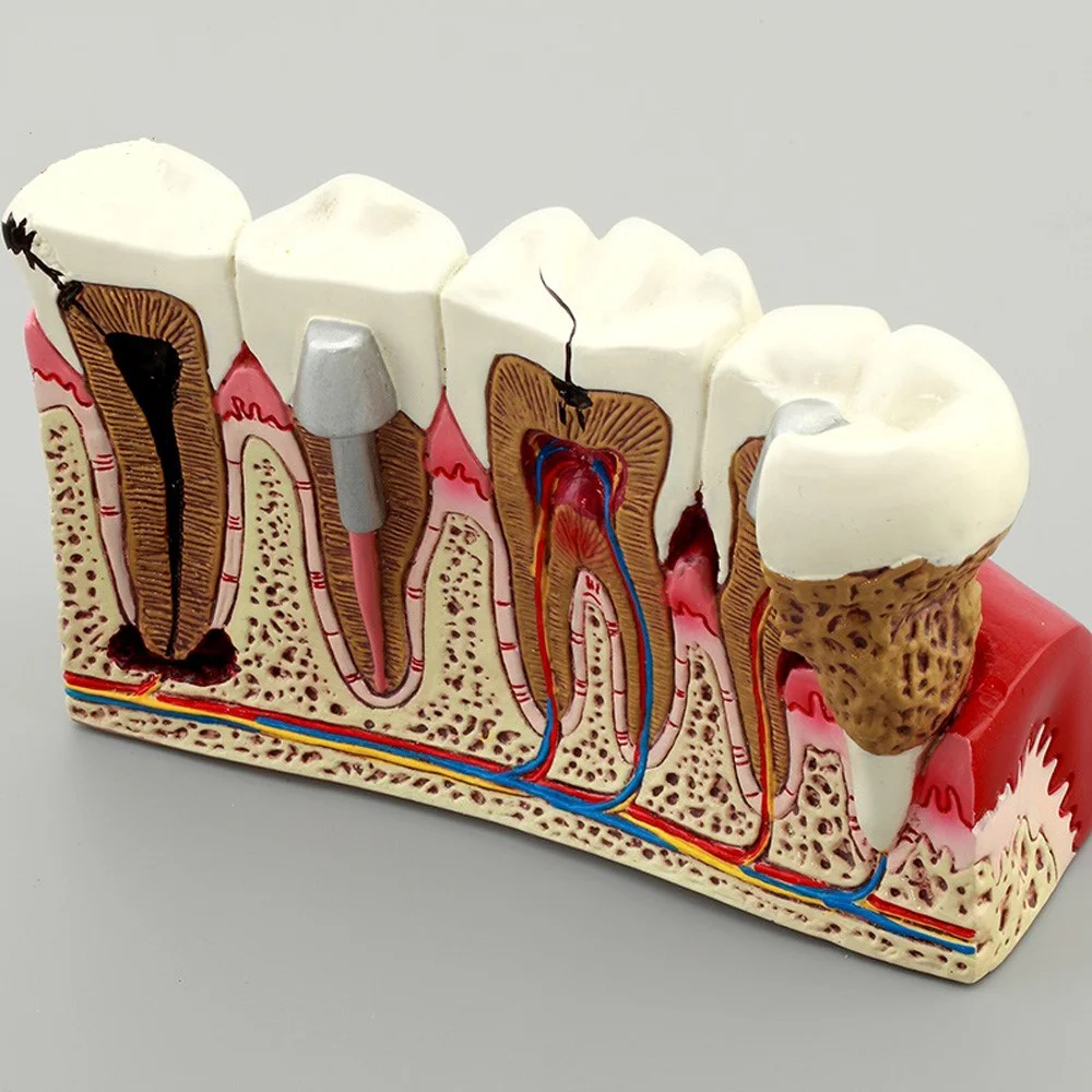 Модель зубных патологий кариес M4029/модель для обучения зубам модель