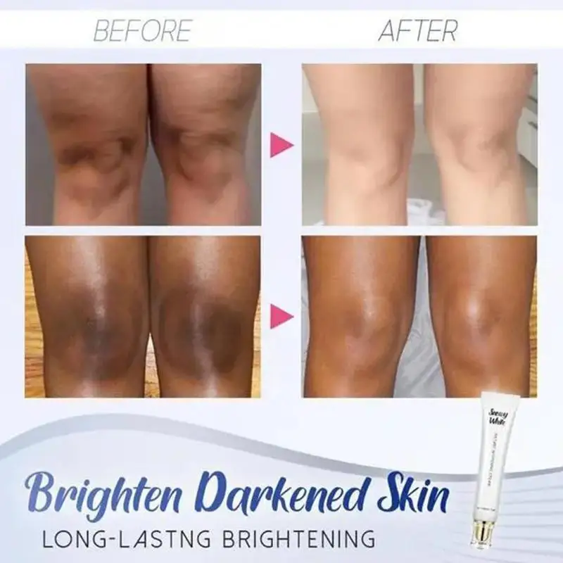 30g Acne Treatment Blackhead Pores Acne Scar Remove Anti Cream Care Cream Shrink Whitening Control Oil Acne Face W1Q2
