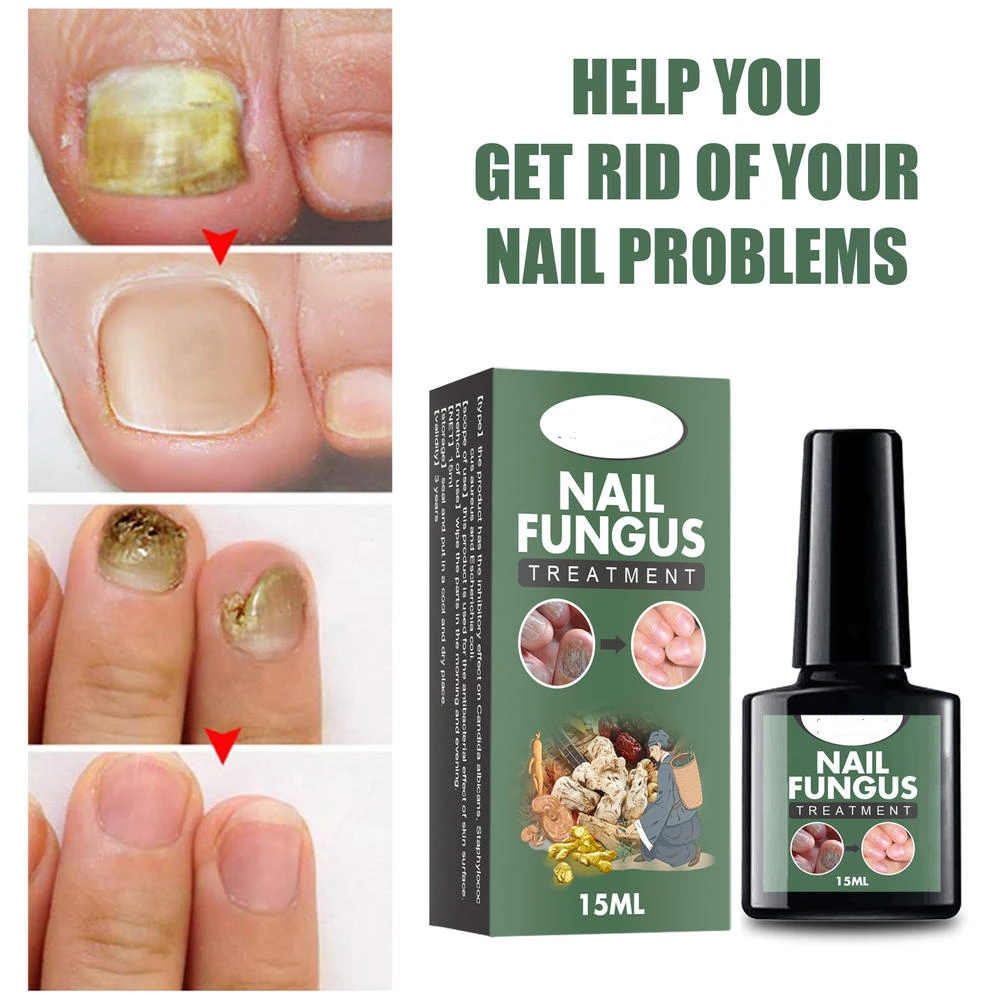 

Nail Fungal Treatment Feet Care Essence Nail Foot Whitening Toe Nail Fungus Removal Gel Anti Infection Paronychia Onychomycosis