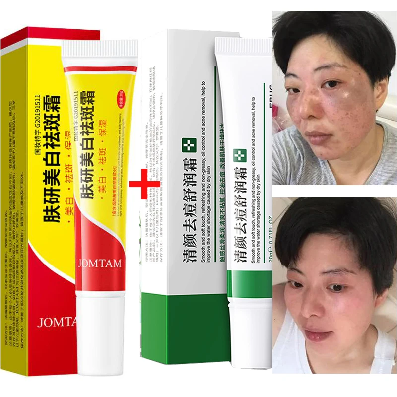 

Whitening Freckle Cream Remove Melasma +Acne Treatment Fade Acne Spots Oil Control Shrink Pore Moisturizing Acne Cream Skin Care