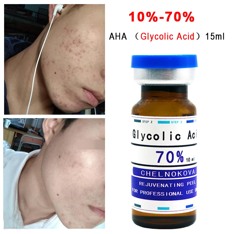 

70% Glycolic Acid Professional Grade Peel AHA Acne print chloasma black spots pregnancy marks exfoliation Skin Bright white15ML