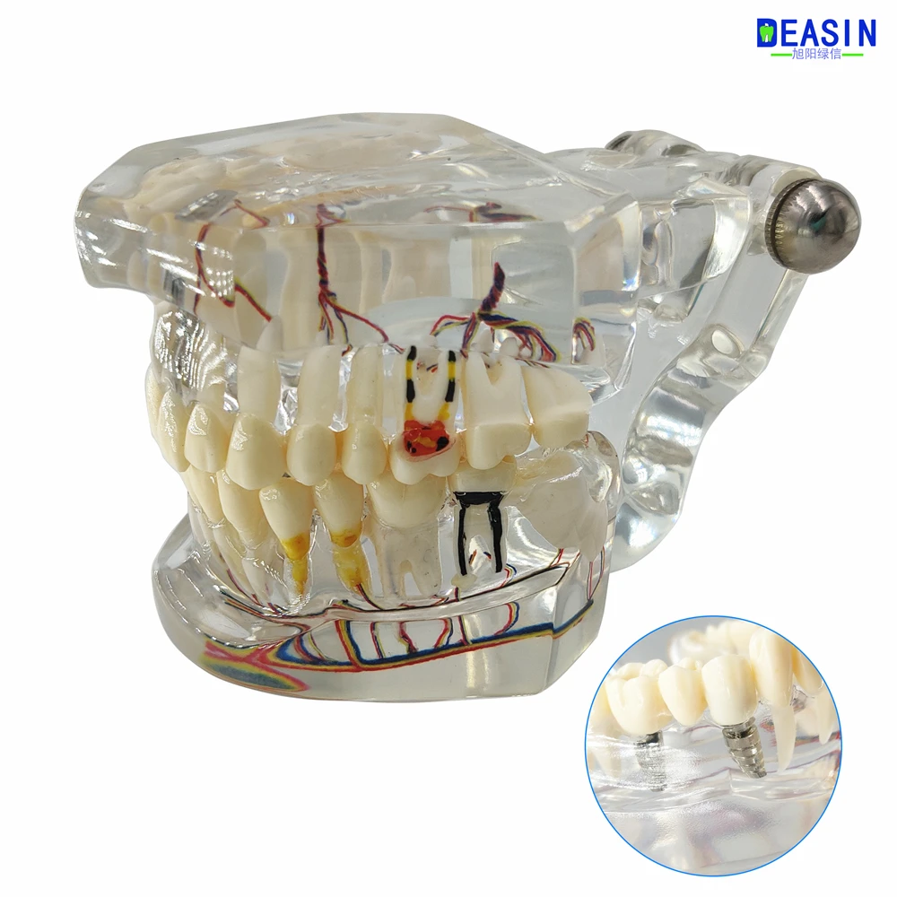 Высокое качество Стоматологическая модель зубов прозрачный патологические