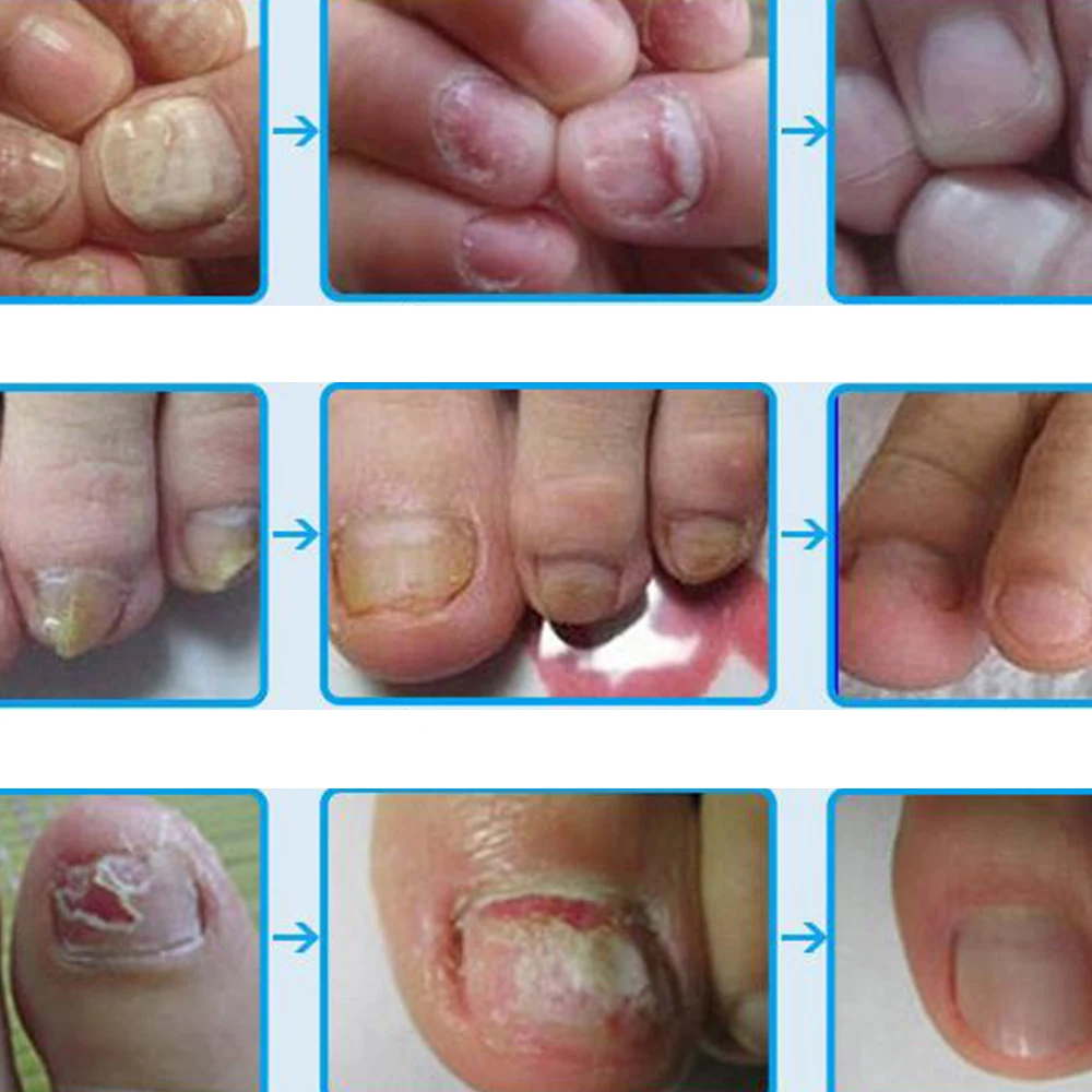 Эффект грибка 3 дня жидкий грибковый препарат для ногтей яркий восстановление