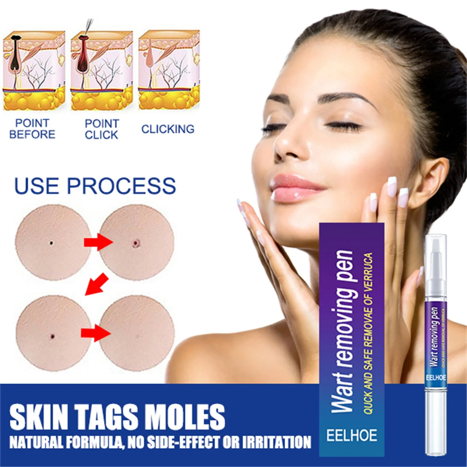 

2PC Warts Remover Antibacterial Ointment Wart Treatment Cream Skin Tag Remover Herbal Extract Corn Plaster Warts Ointment