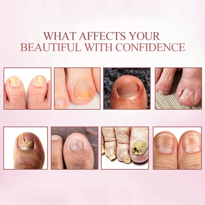 Уход за ногтями эфирное масло для ног массажер традиционная китайская медицина