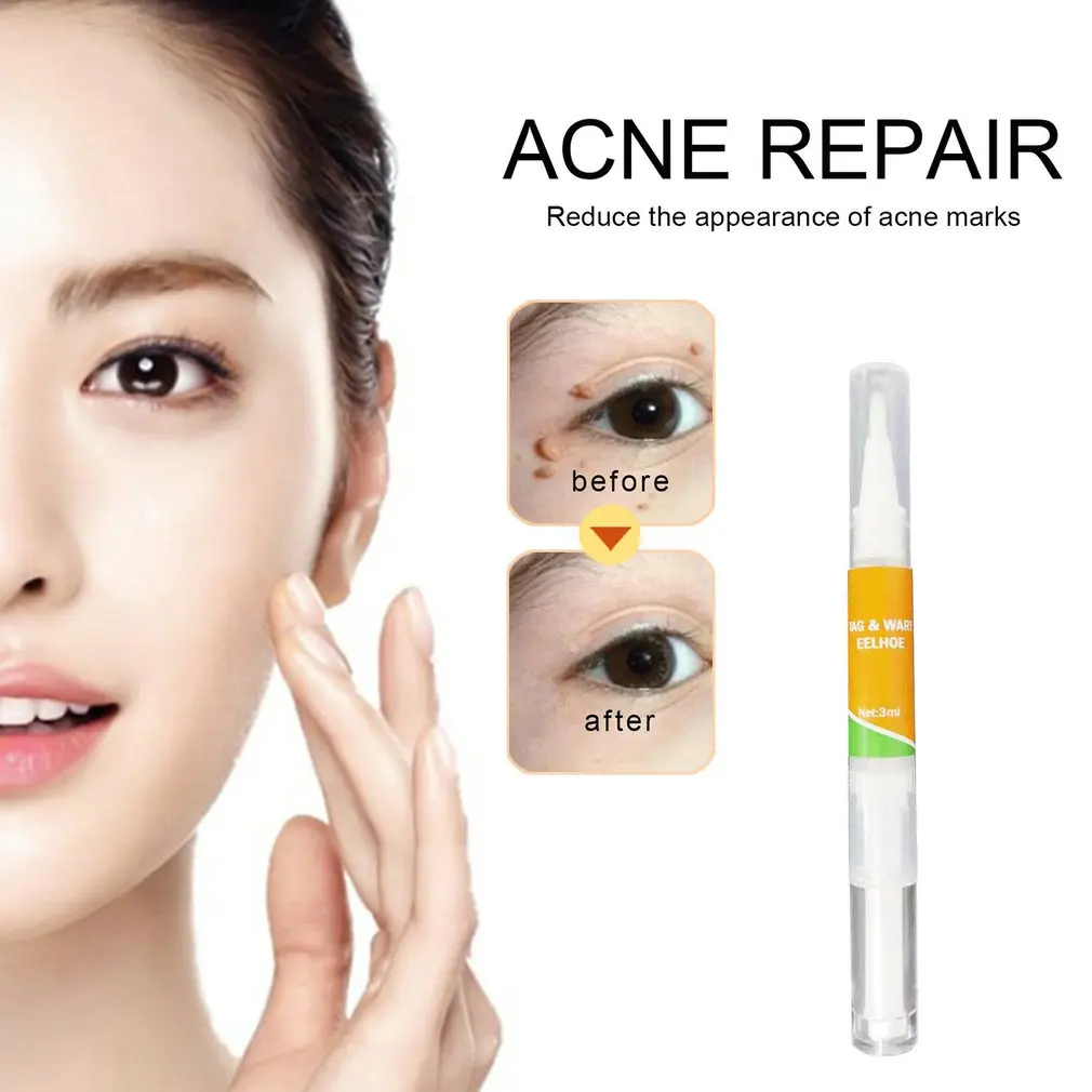 

Point Mole Pen Removal Of Nevus Planus Care Repair Solution No Trace High Performance Penetration Nevus Removal Tool
