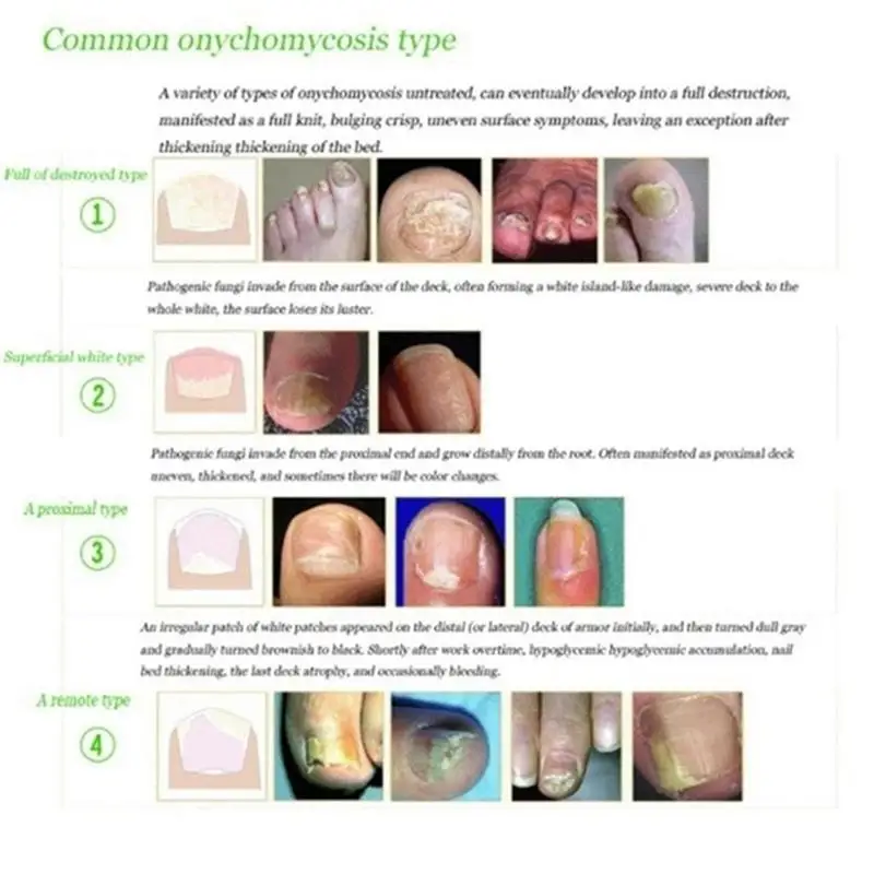 

Foot hand Nail Bright Repair Treatment Nail Oil Anti Fungus Infection