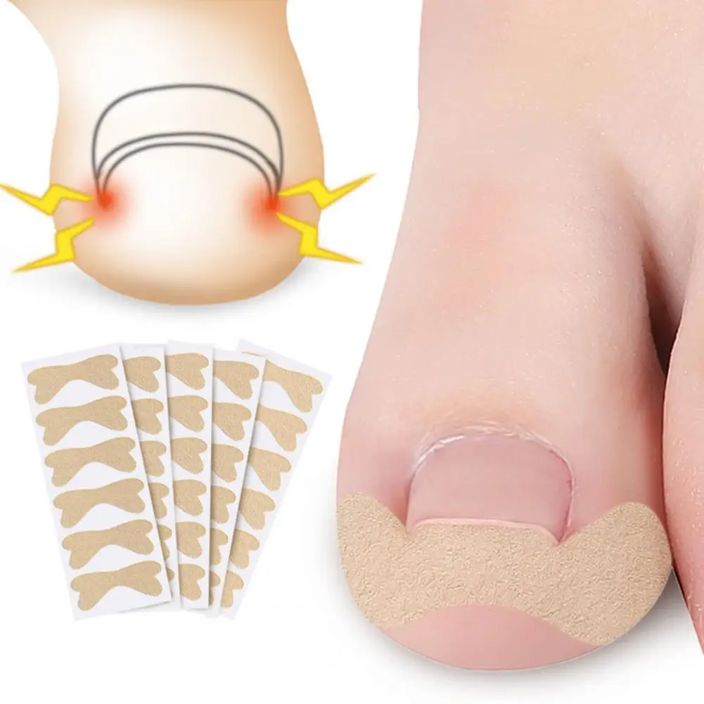 24Pcs Butterfly Shape Toenail Ingrown Patch Drop-Down Ultra Thin Nail Correcting Ingrown Patch for Unisex