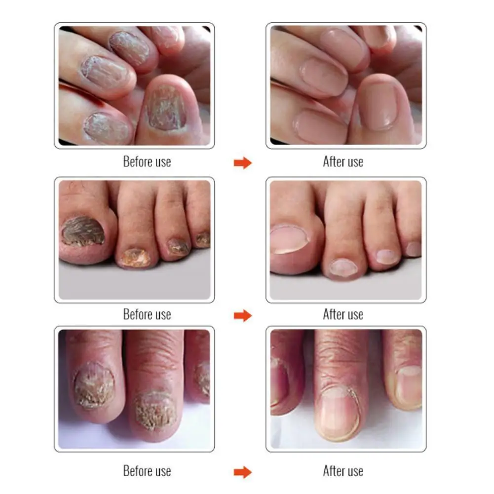 

5ML Natural Plant Extracts Anti Fungal Treatment Anti Bacterial Repair Treatment Liquid Nail Antibacterial Solution