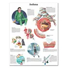 WANGART схема для астмы, плакат, печать на холсте, настенные картины для медицинского обучения, врачей, офисных классов, без рамки