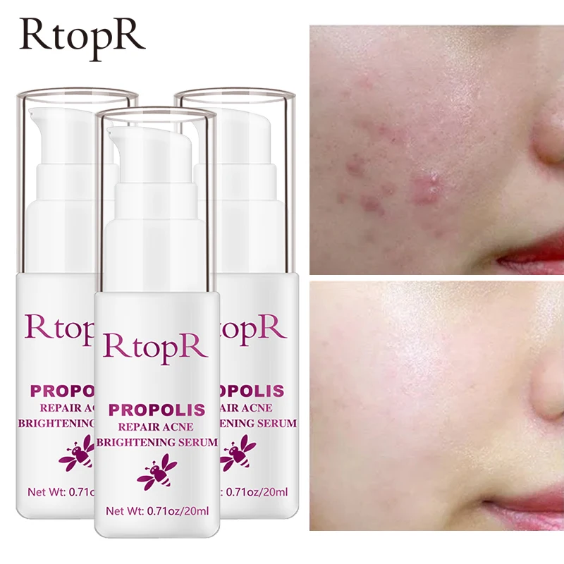 

1pc RtopR Acne Brightening Essence Acne Scar Repair Moisturizing Serum Shrinkage Elimination Acne Treatment Propolis Oil Control