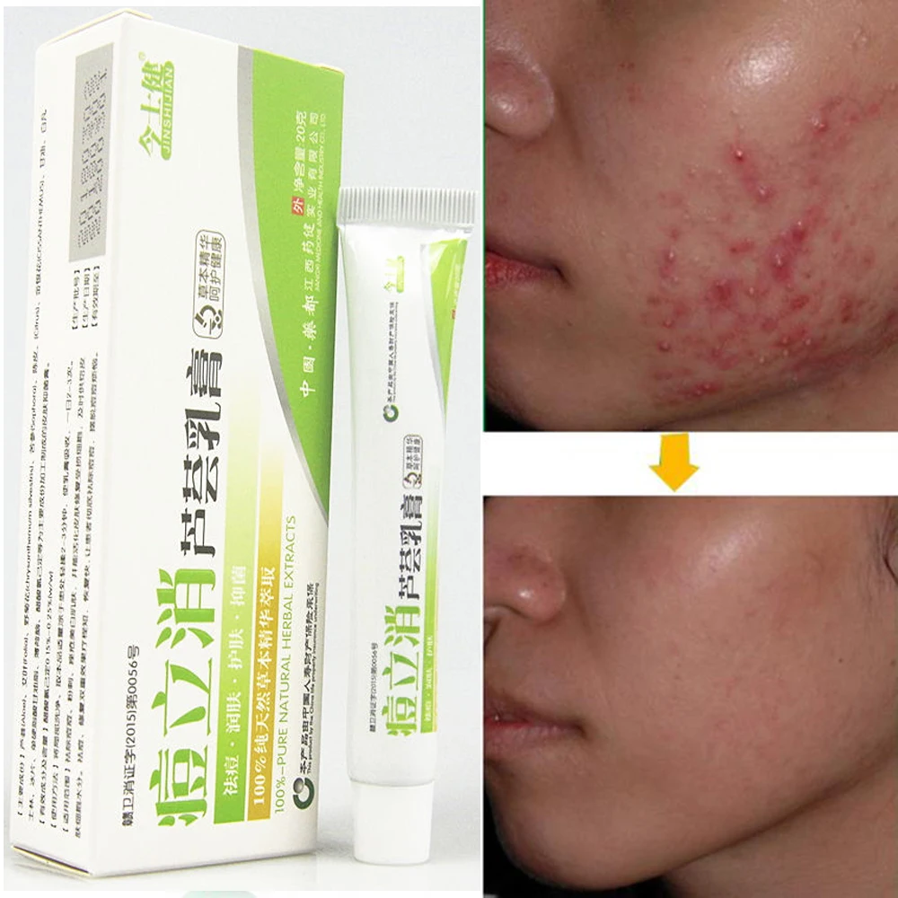 

Косметические продукты, крем для лица, акне, контроль жирности и удаление акне, крем для лица, акне, 1 шт.