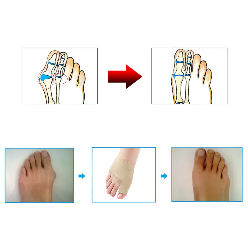 Коррекция большого пальца ноги большой палец вальгус подушка Hallux рельеф