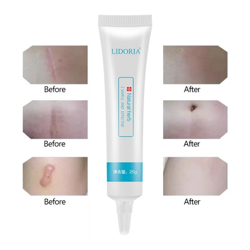 Remove Pimple 20g Skin Smoothing Cream Repair Essential Liquid Hydrating Marks Skin Care Serum