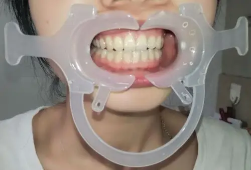 5 шт. зубные щеки губы Втягивающее Рот открывалка C Форма с ручкой цвет: белый