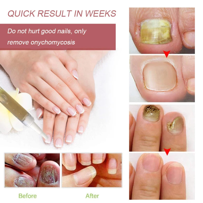 

Nail Treatment Pen Anti-fungal Home Treatment Set Toe Onychomycosis Paronychia Anti Fungal Fungus Care Repair Serum Kit TSLM1