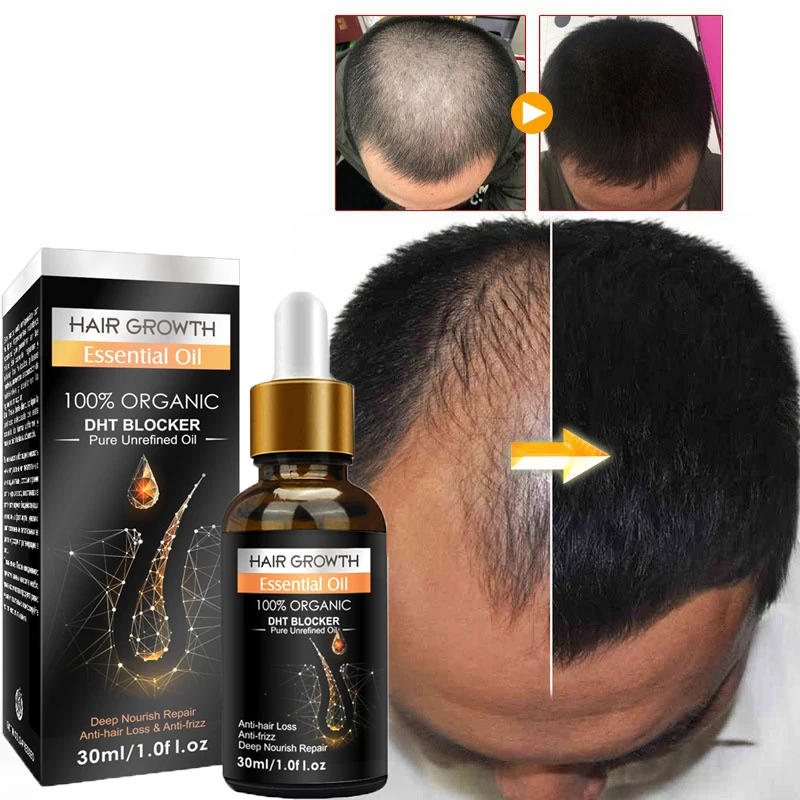 

Ginger Hair Growth Essential Oils Promote Hair Regrowth Essence Prevent Baldness Hair Loss Hair Serum Anti-hair Loss Hair Care