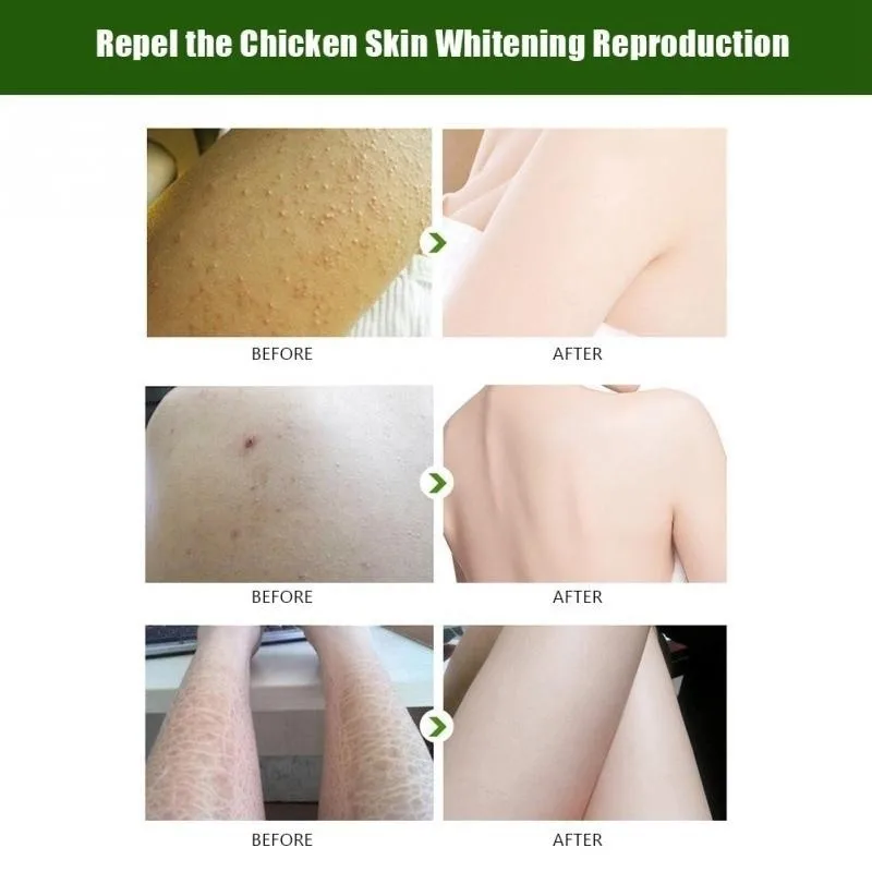 

full-body whitening chicken skin Essence repair essential oils remove dead skin goose bumps pimples folliculitis Essence
