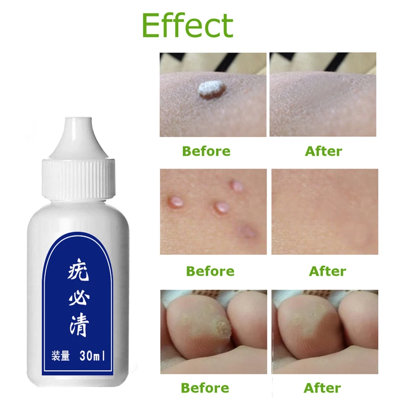 

10ML Skin Tag Remover Genital Wart Treatment Instant Removal Mole&Papillomas Foot Corn Repair Tool Natural Bacteriostatic Liquid